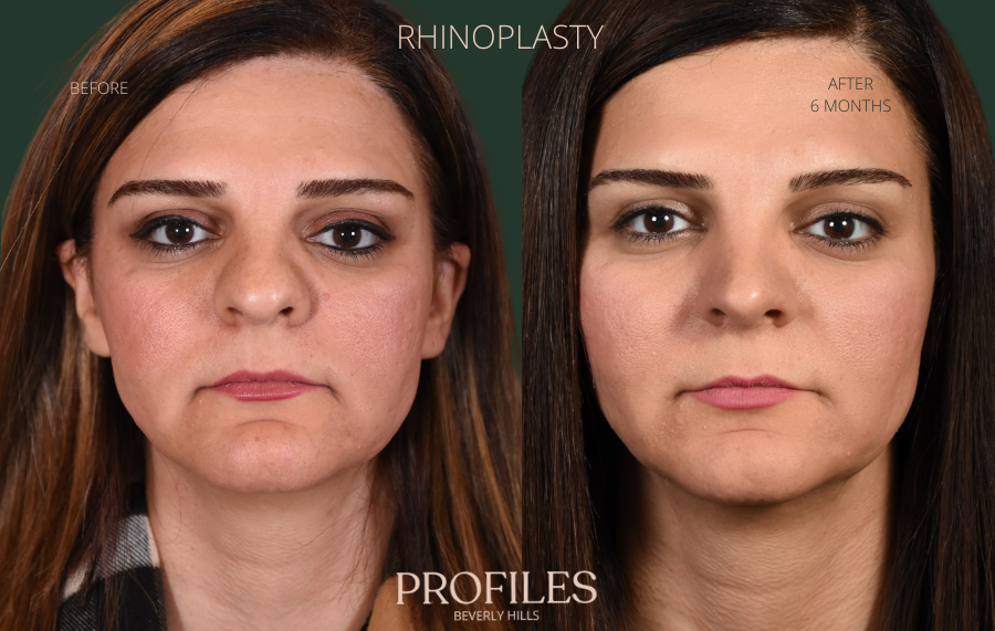 Woman's face, before and after Rhinoplasty treatment, front view, patient 3