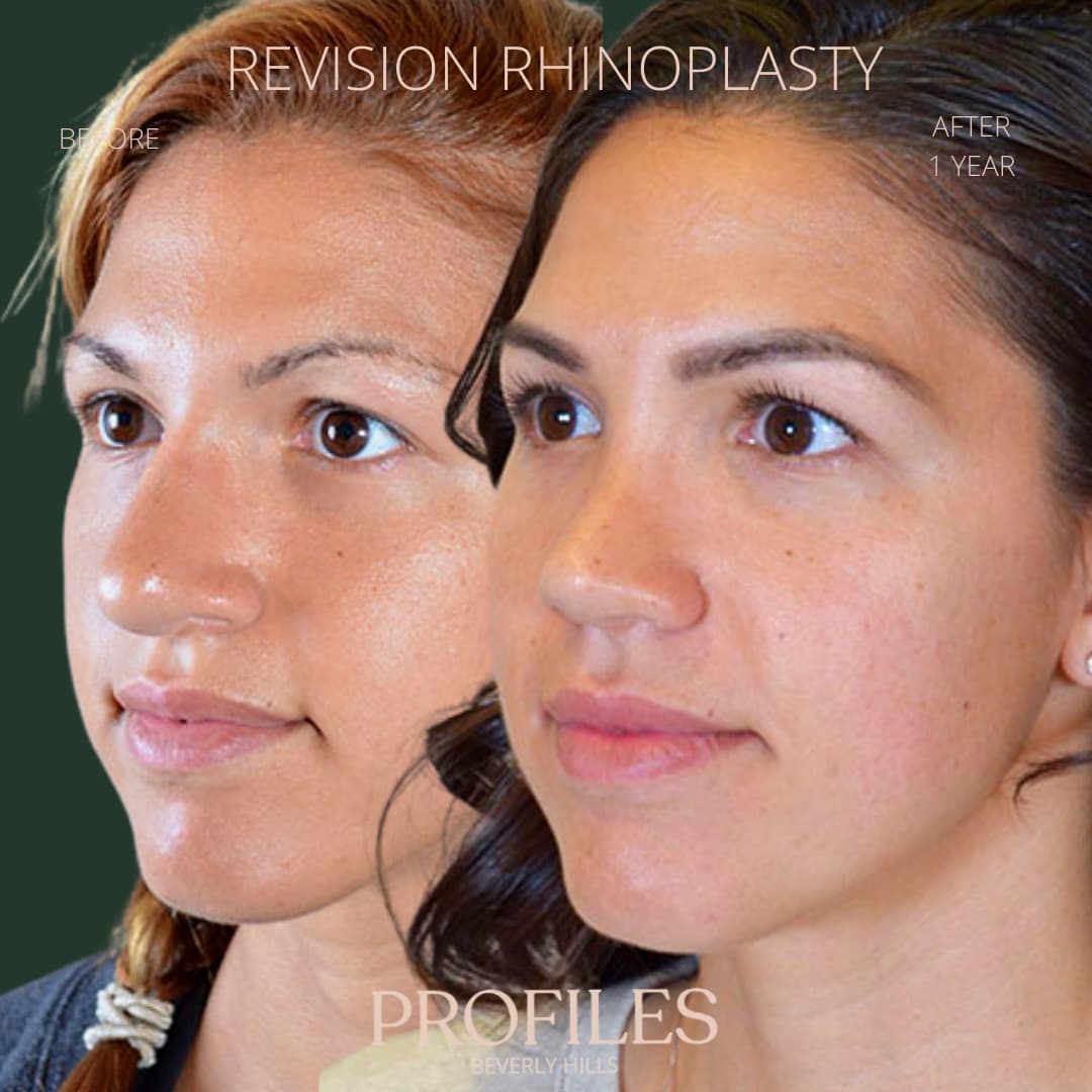 Woman’s face, before and after Revision Rhinoplasty treatment, l-side oblique view, patient 9