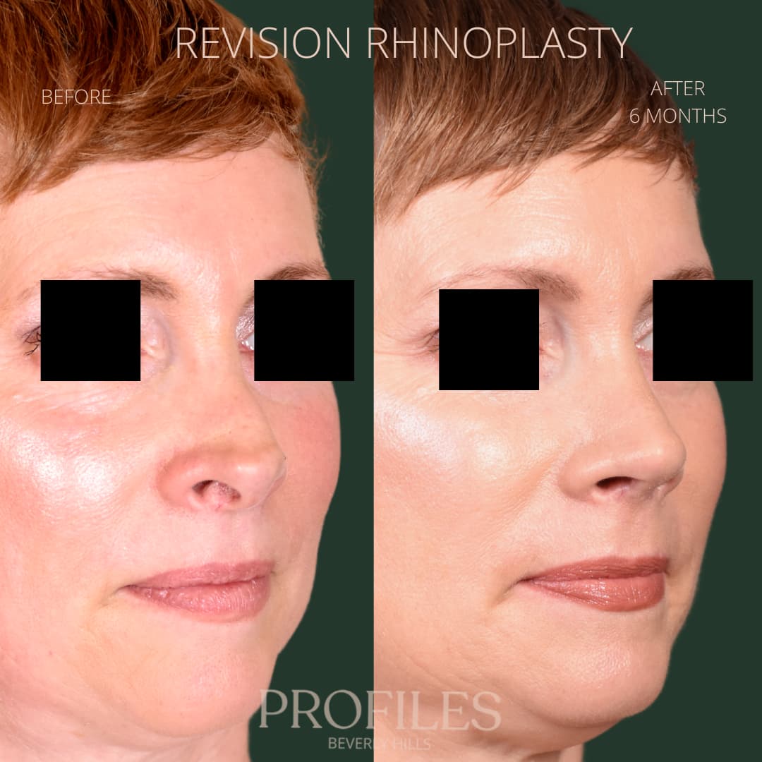 Woman’s face, before and after Revision Rhinoplasty treatment, r-side oblique view, patient 7