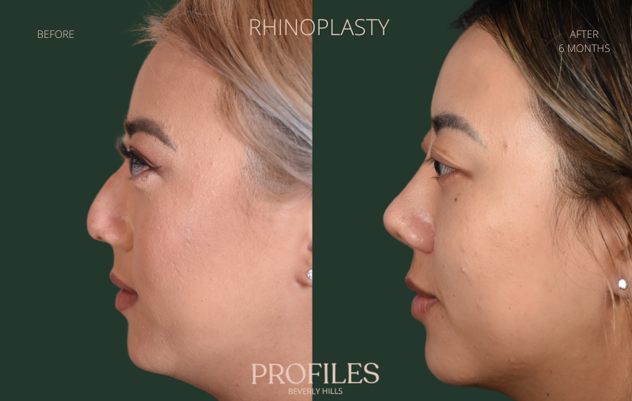 Woman's face, before and after Rhinoplasty treatment, l-side view, patient 4