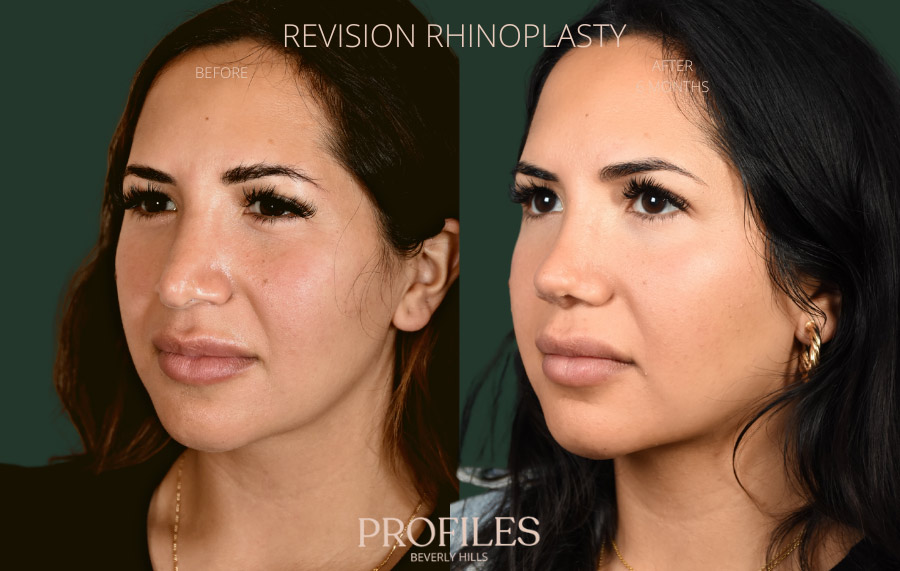 Revision Rhinoplasty Before and After Photo Gallery - l-side oblique view, female patient 40