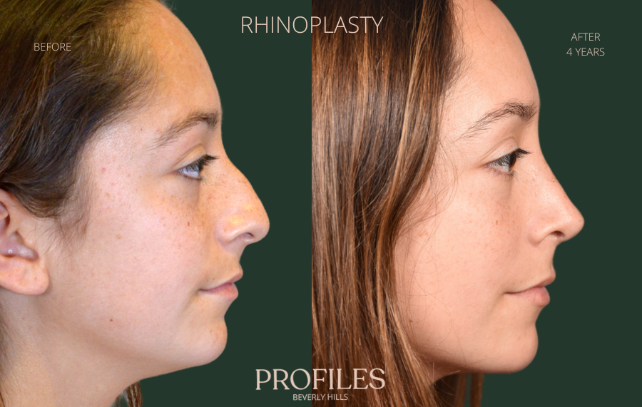 Woman's face, before and after Rhinoplasty treatment, r-side view, patient 10