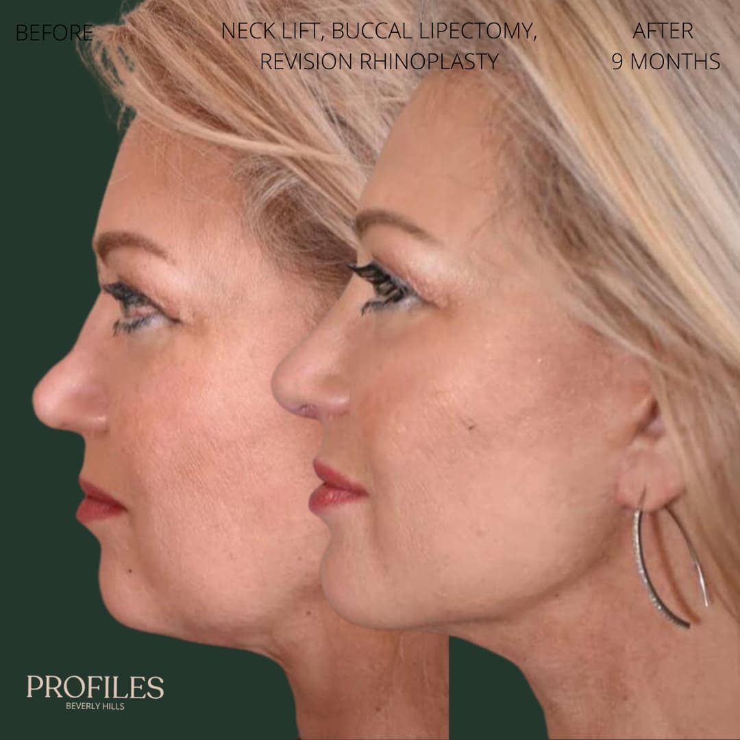 Female face, before and after Revision Rhinoplasty treatment, l-side view, patient 2