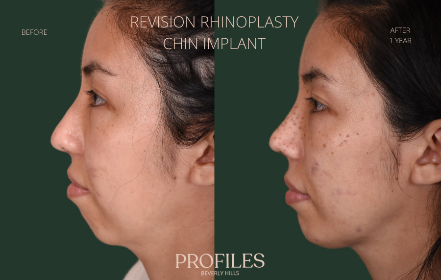 Female face, before and after Chin Implant treatment, l-side view, patient 13