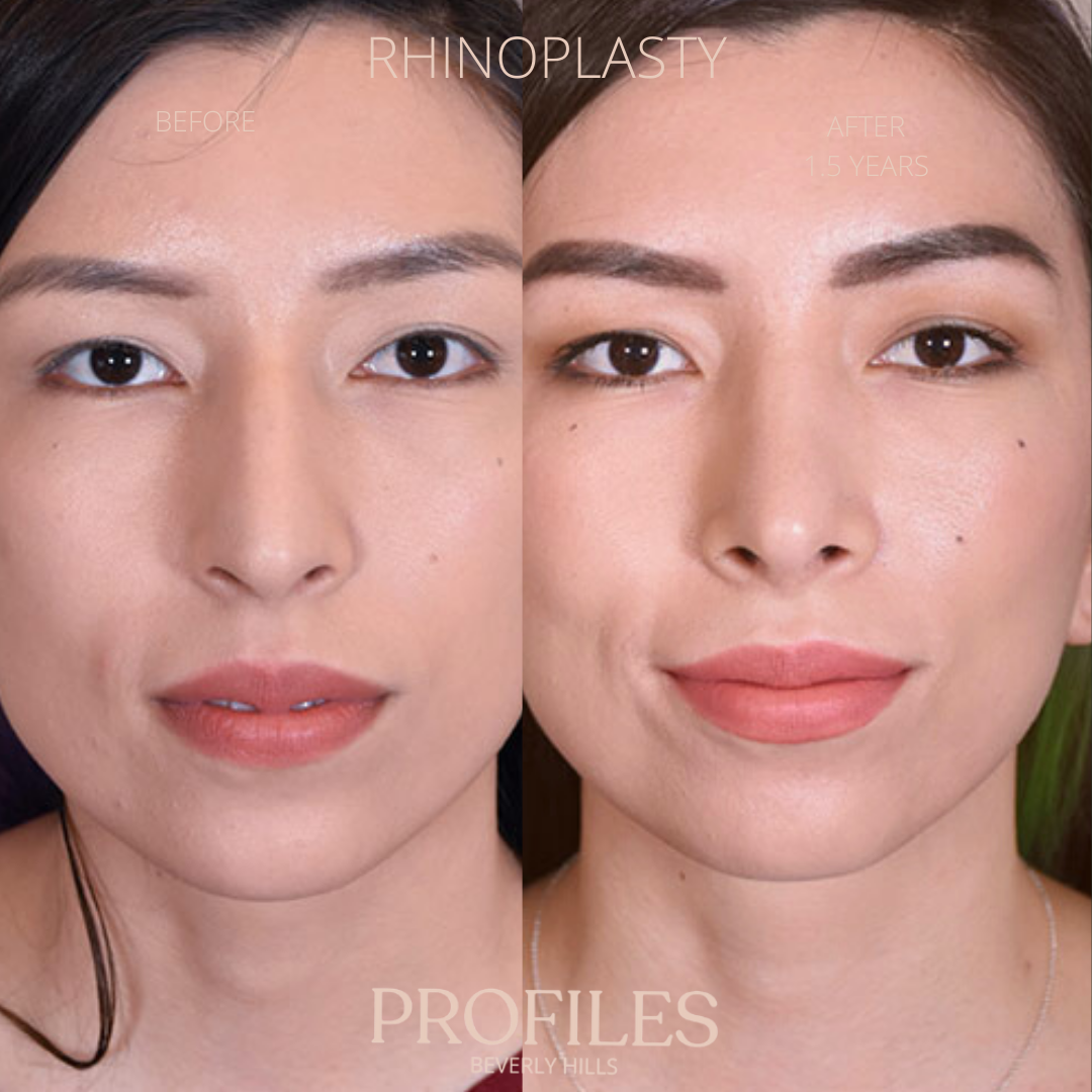 Before/After