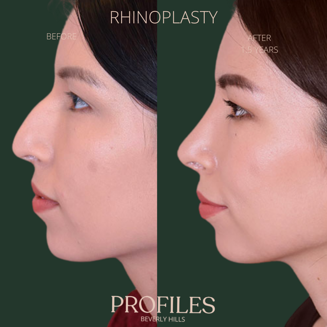 Woman’s face, before and after Ethnic Rhinoplasty treatment, l-side view, patient 2