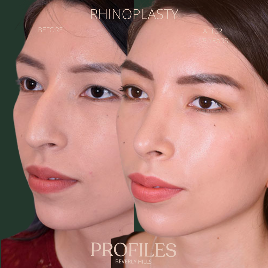 Woman’s face, before and after Ethnic Rhinoplasty treatment, l-side oblique view, patient 2