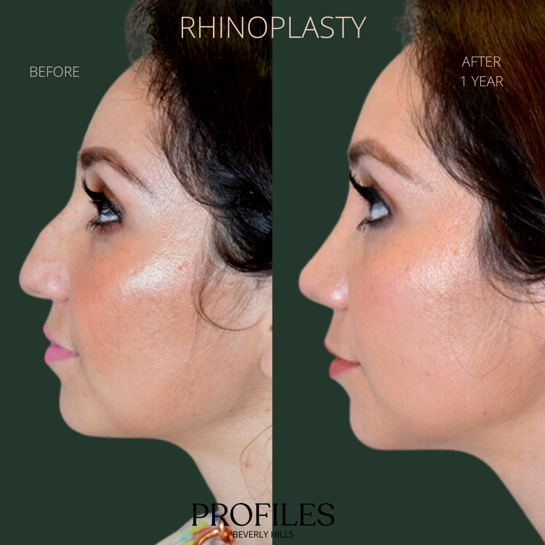 Woman’s face, before and after Ethnic Rhinoplasty treatment, l-side view, patient 3