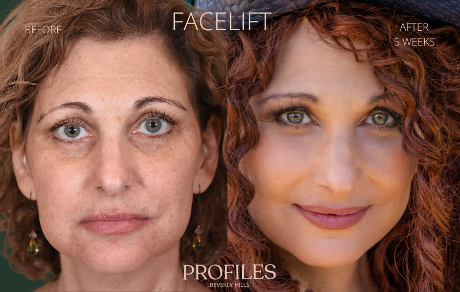 Facelift Before & After Photos, Beverly Hills