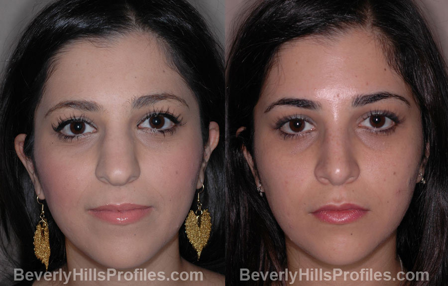 Woman’s face, before and after Ethnic Rhinoplasty treatment, front view, patient 4