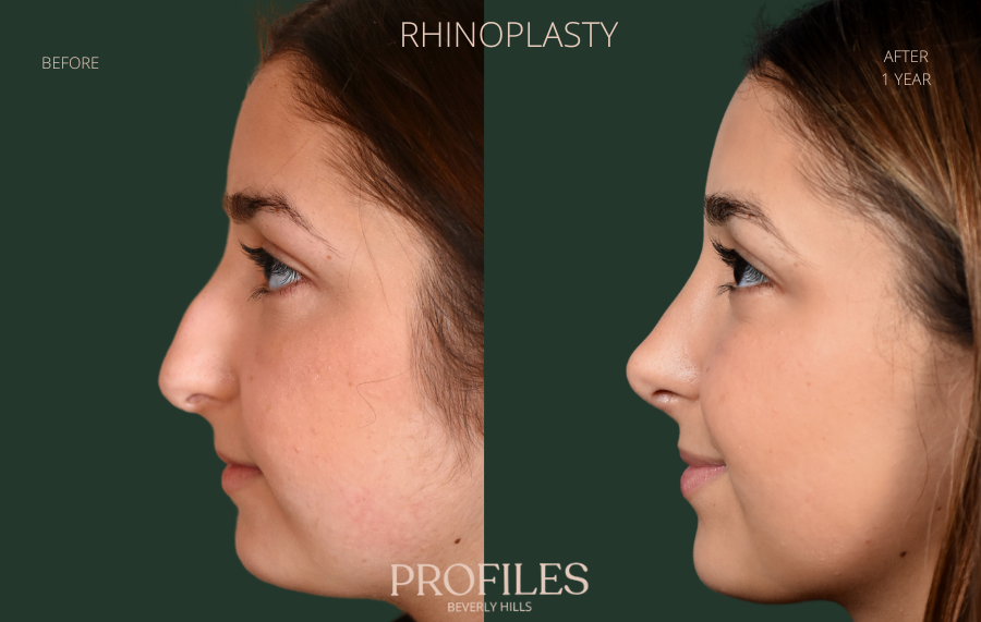 A better lip-nose contour and more refined nasal tip were achieved during  this nose job