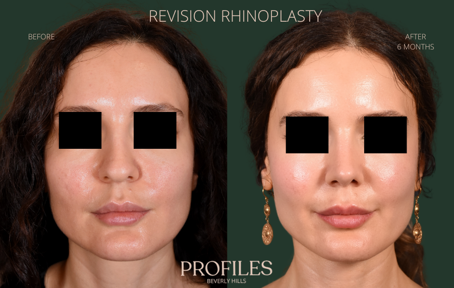 Revision Rhinoplasty Before and After Photo Gallery - front view, female patient 39