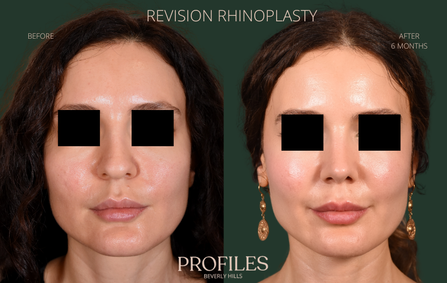 Septoplasty: Breathing Before, Swelling After, Results