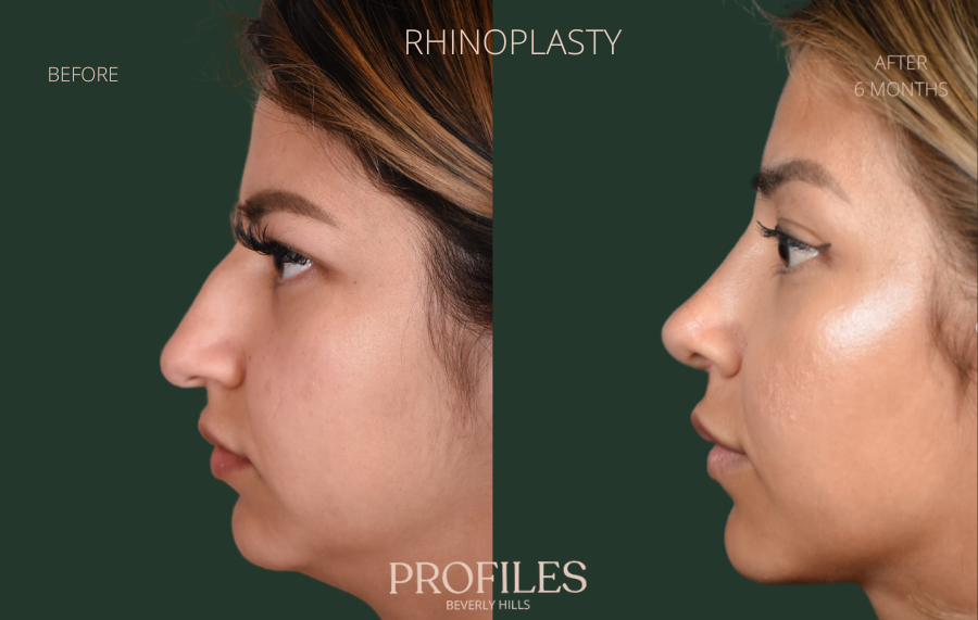 Woman's face, before and after Rhinoplasty treatment, l-side view, patient 1