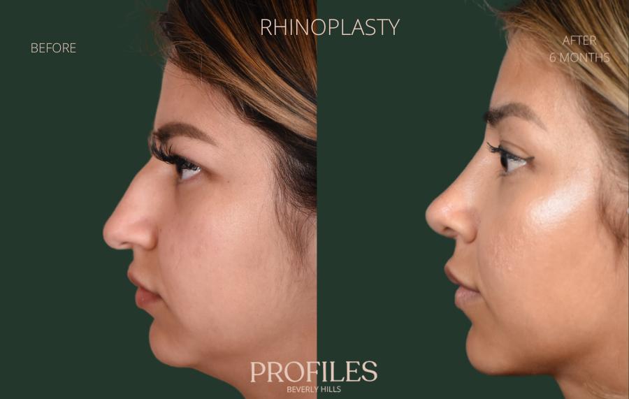 Rhinoplasty