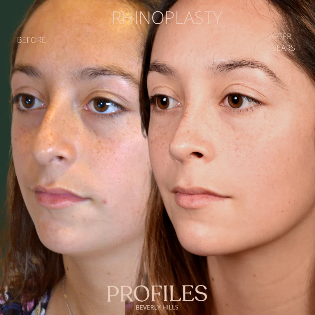 Woman’s face, before and 4 years after Rhinoplasty treatment, oblique view, patient 1