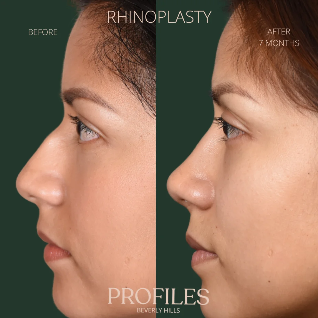 Woman’s face, before and 7 months after Rhinoplasty treatment, l-side view, patient 2