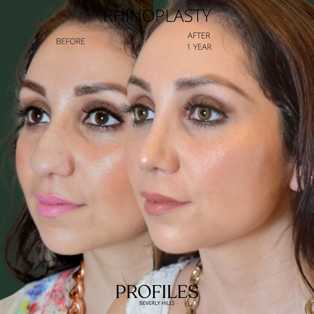 Woman’s face, before and 1 year after Rhinoplasty treatment, oblique view, patient 4