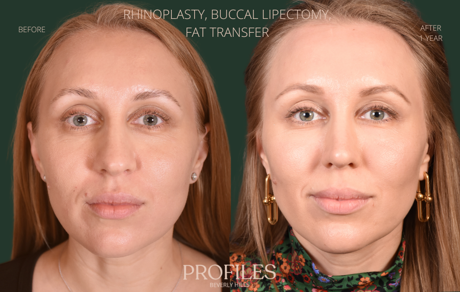 Woman's face, before and after Rhinoplasty treatment, front view, patient 7