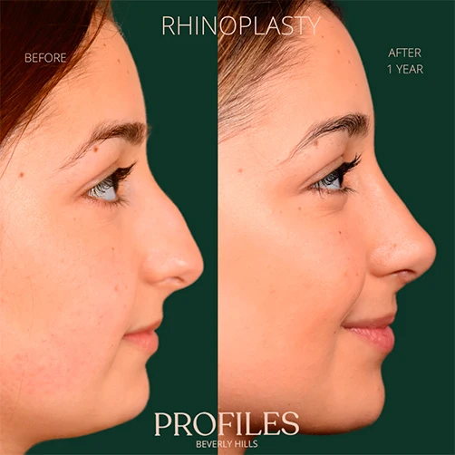 Woman’s face, before and 1 year after Rhinoplasty treatment, r-side view, patient 5