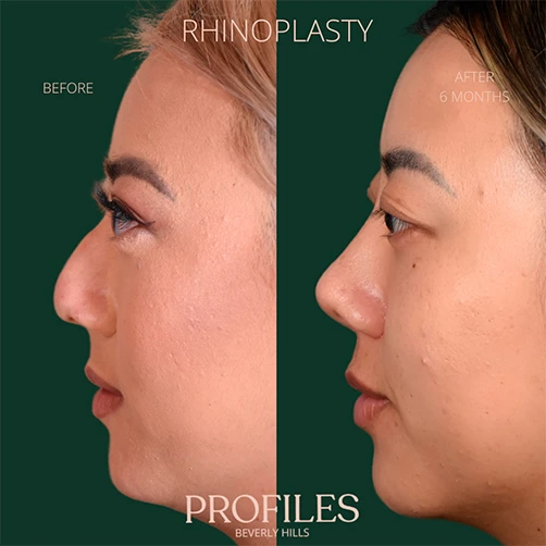 Woman’s face, before and 6 months after Rhinoplasty treatment, l-side view, patient 11
