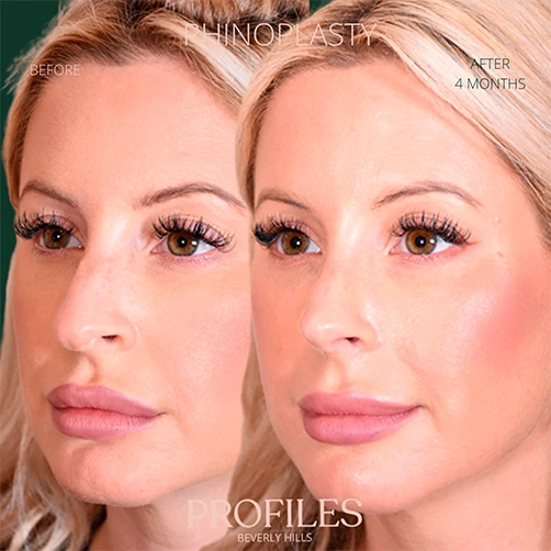 Woman’s face, before and 4 months after Rhinoplasty treatment, l-side oblique view, patient 9