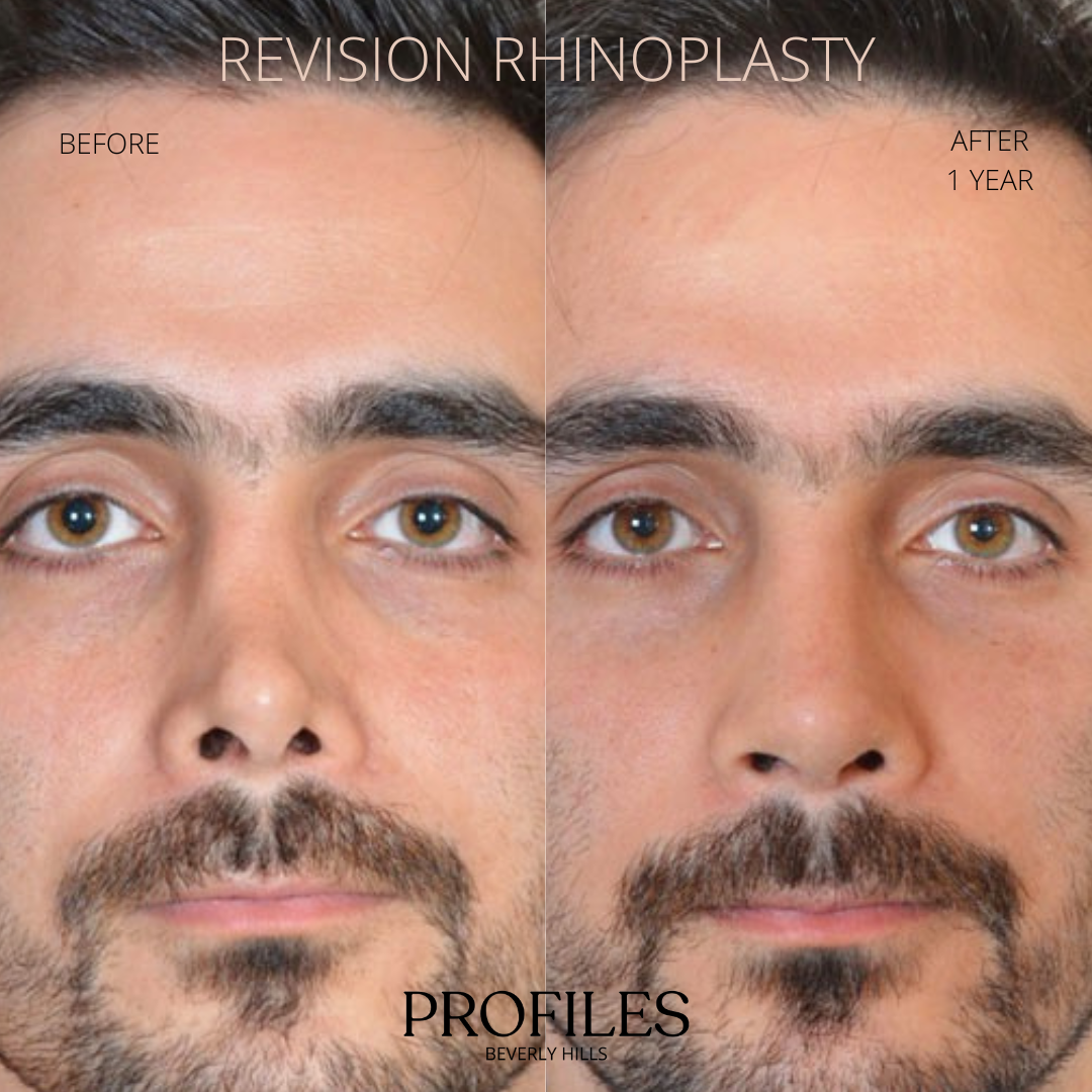Male face, before and after Revision Rhinoplasty treatment, front view, patient 1