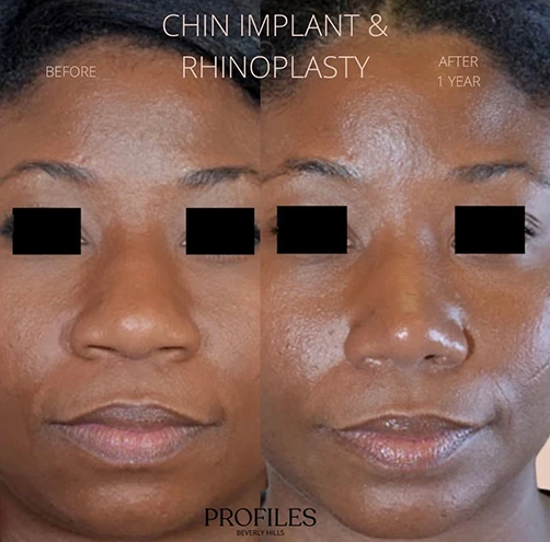 Woman’s face, before and 1 year after Rhinoplasty treatment, front view, patient 8