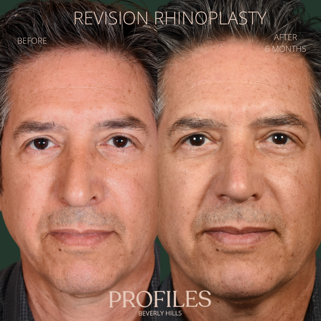 Before/After