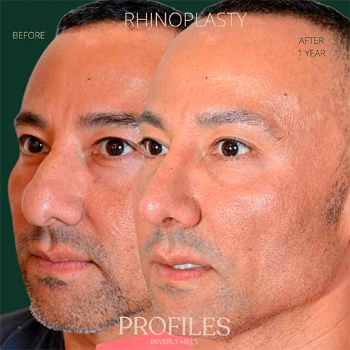 Male face, before and 1 year after Rhinoplasty treatment, oblique view, patient 13