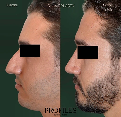 Male face, before and 1 year after Rhinoplasty treatment, l-side view, patient 7