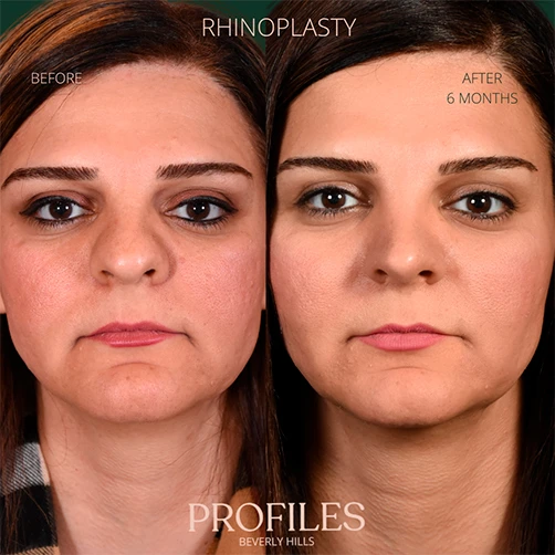 Woman’s face, before and 6 months after Rhinoplasty treatment, front view, patient 6