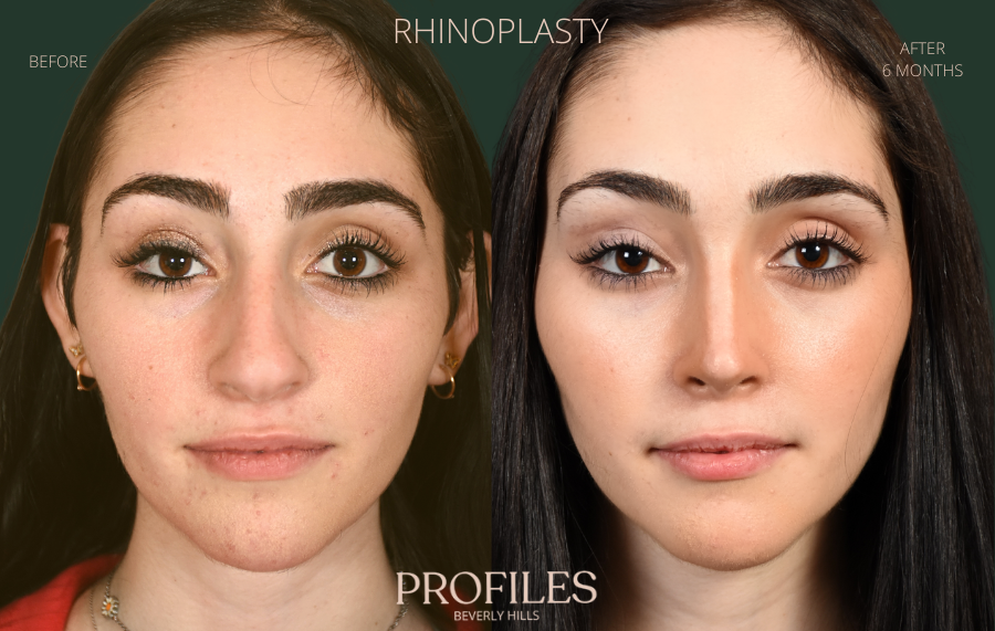 Woman's face, before and after Rhinoplasty treatment, front view, patient 114