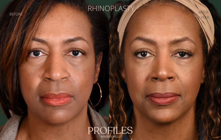 Woman's face, before and after Rhinoplasty treatment, front view, patient 113