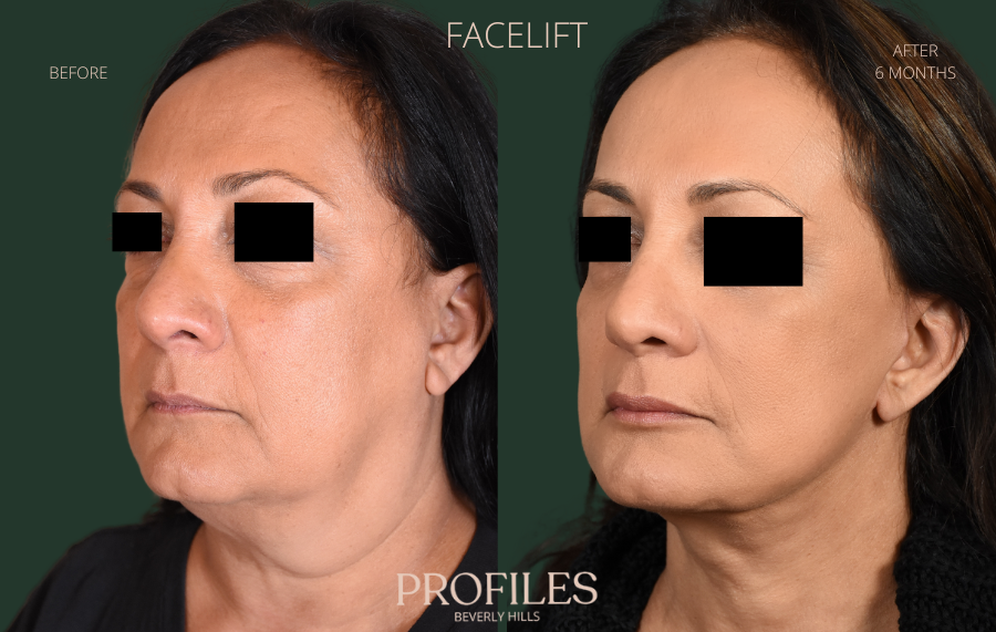 🥳 New Year Full Face Lift  Forehead Lift, Eyebrow Lift, Eyelid