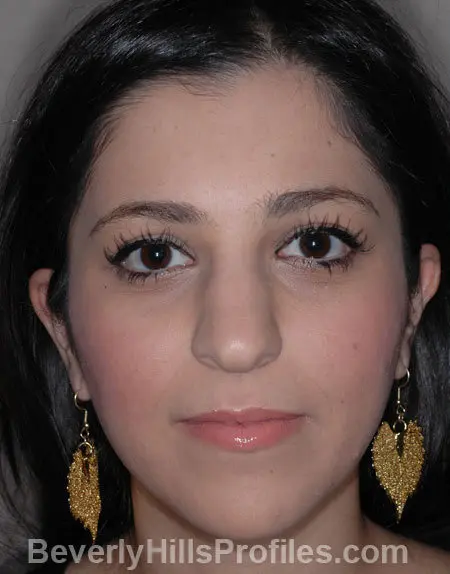 Female-Rhinoplasty