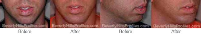 Male face, before and after Chin Implants treatment, front/side view, patient 1