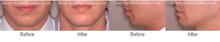Male face, before and after Chin Implants treatment, front/side view, patient 2
