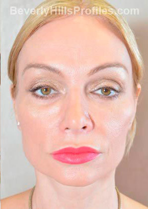 Woman’s face, before Brow Lift treatment, front view, patient 2