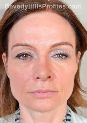 Woman’s face, after Brow Lift treatment, front view, patient 2