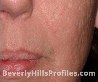 Female face, after SURGICAL SCARS REMOVAL Treatment