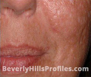 Female face, before SURGICAL SCARS REMOVAL Treatment