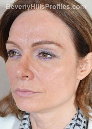 Woman’s face, before Brow Lift treatment, l-side oblique view, patient 2