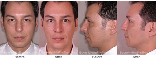 Male face, before Fat Grafting treatment, front view, patient 1