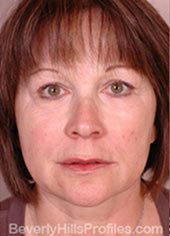 Woman’s face, after Brow Lift treatment, front view, patient 1