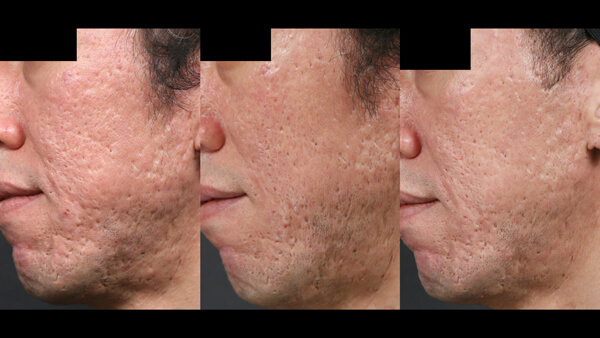 Male face, before and after Potenza Microneedling Treatment, l-side view, patient 1