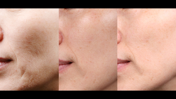 Female face, before and after Potenza Microneedling Treatment, l-side view, patient 2