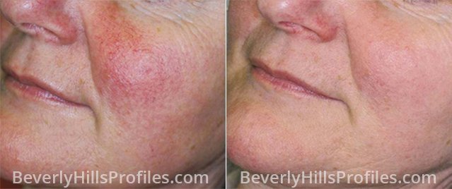 Rosacea Before and After Treatment Photos: female face, oblique view, patient 1