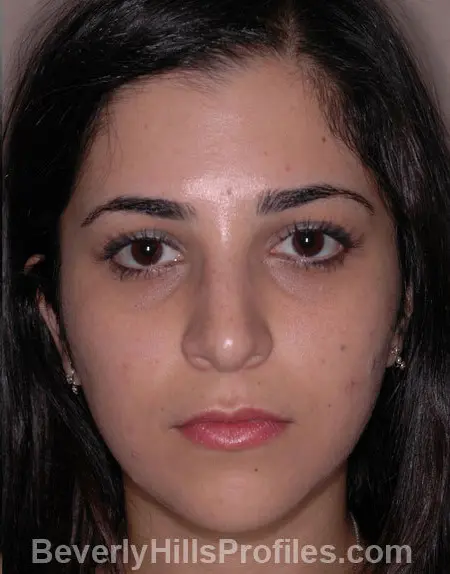 Woman’s face, after Ethnic Rhinoplasty treatment, front view, patient 4