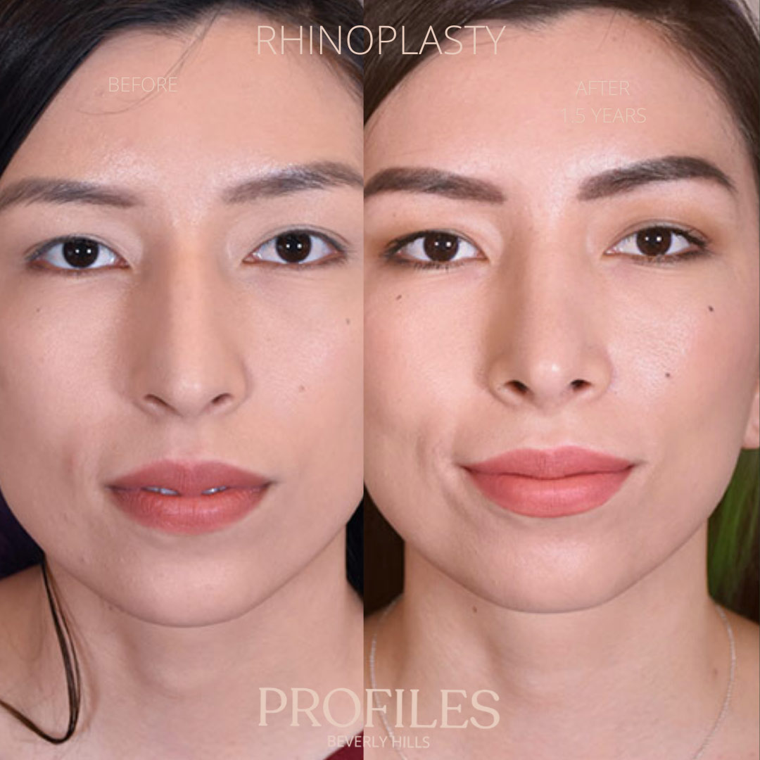 Woman’s face, before and after Ethnic Rhinoplasty treatment, front view, patient 2